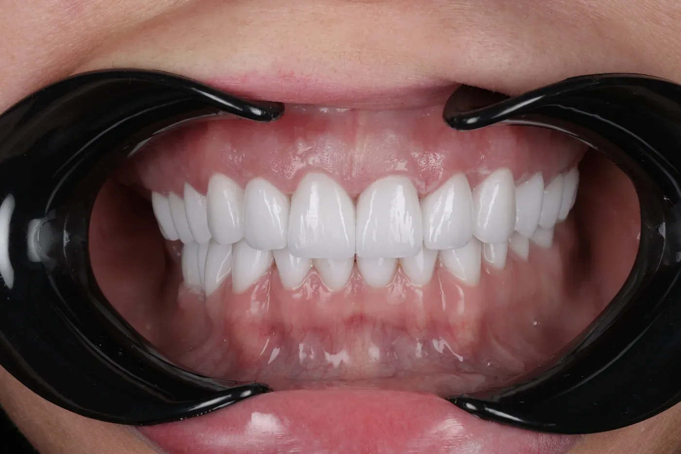 Rezultat estetic dentar, dantură fixă All-on-X, Clinica NEO Baia Mare