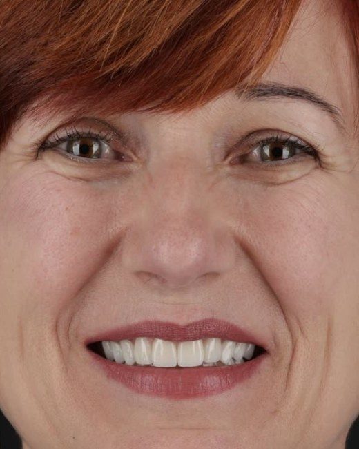 Transformare zâmbet, rezultat după, Clinica NEO Baia Mare