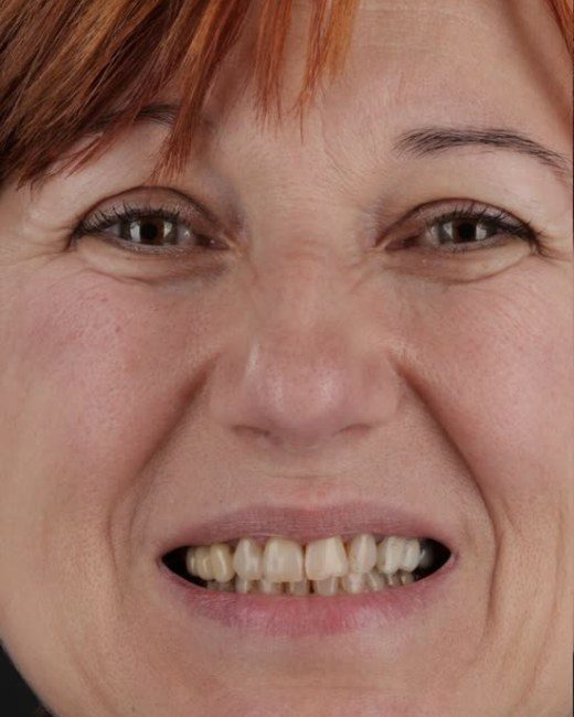 Transformare zâmbet, înainte, Clinica NEO Baia Mare