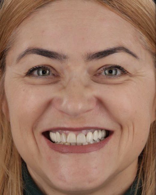 Transformare zâmbet, înainte, Clinica NEO Baia Mare