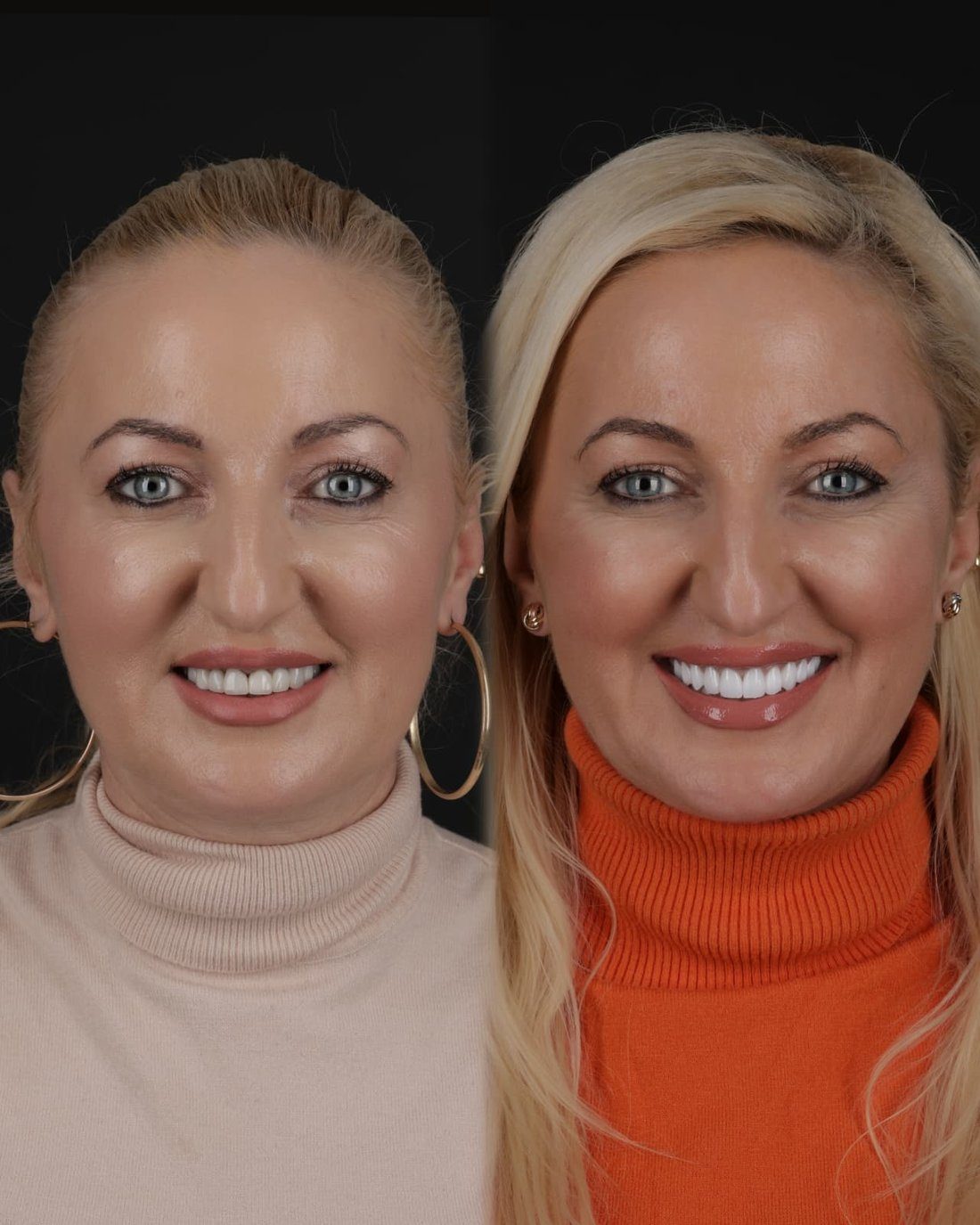 Coroane dentare Baia Mare, caz real înainte și după, Clinica NEO